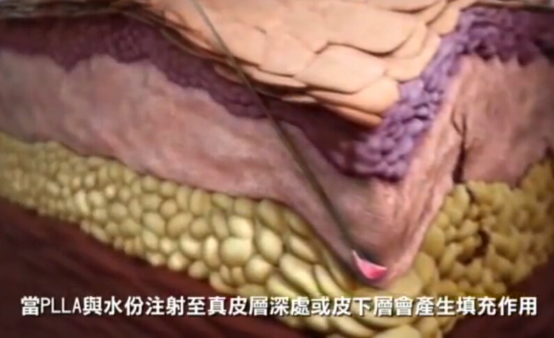 面部骨胶原增生原理动画演示