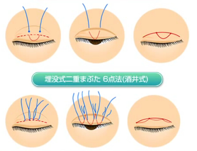 埋线双眼皮操作演示