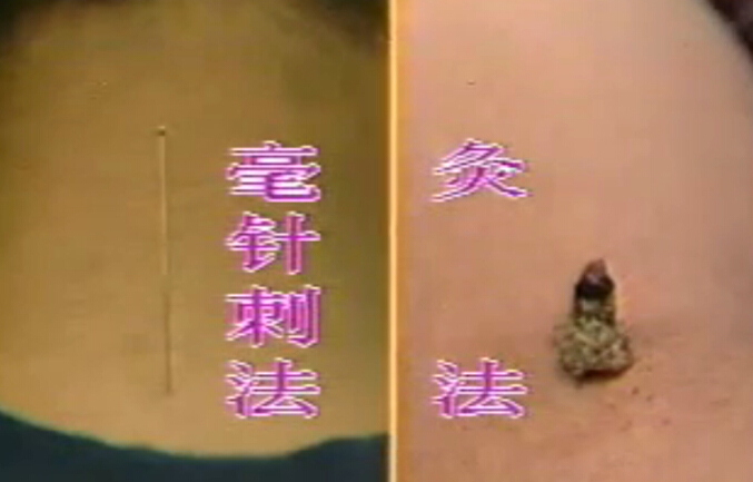 针灸各个方法介绍