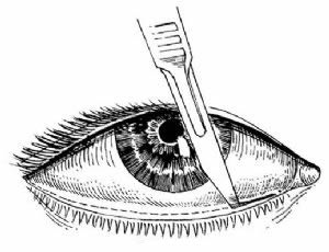 下睑外翻,眼袋整形术并发症,下睑外翻治疗体会