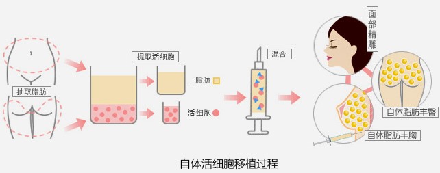 你了解自体脂肪移植吗