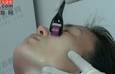 Easpeer细胞修复因子微针治疗