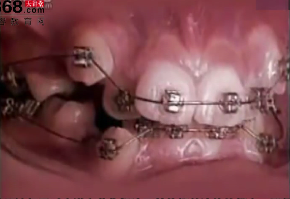 29秒看完牙齿矫正后的效果