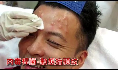 肉毒杆菌：大叔变型男