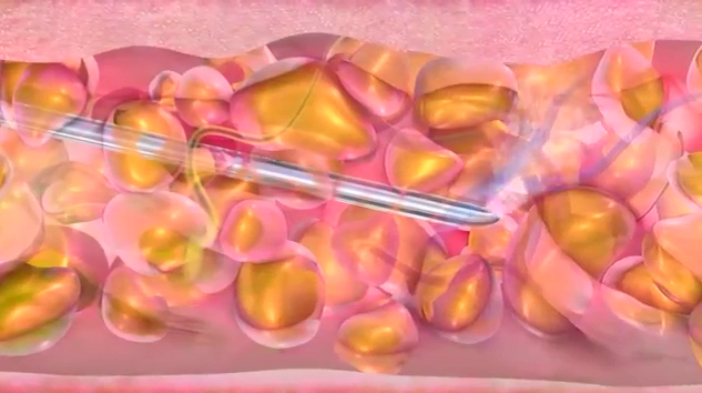 水刀抽脂原理及过程演示