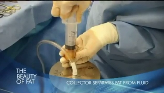 水刀抽脂丰胸步骤示范