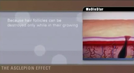 冰晶无痛除毛镭射介绍