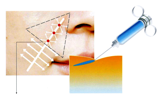 弓针注射技术与蕨叶式注射技术介绍