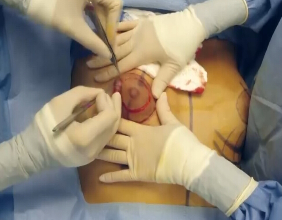 结节状乳房畸形的治疗