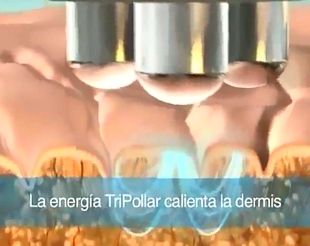 三极电波拉皮介绍