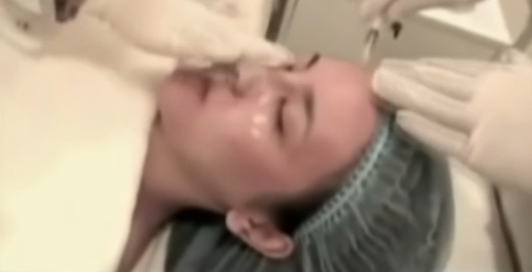 体验微针全过程