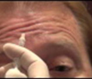 肉毒素祛除抬头纹