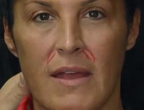 ELLANSÉ™填充苹果肌、法令纹、嘴角肉