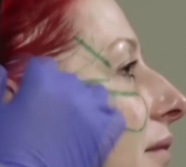 ELLANSÉ™注射消除鱼尾纹，填充面颊部