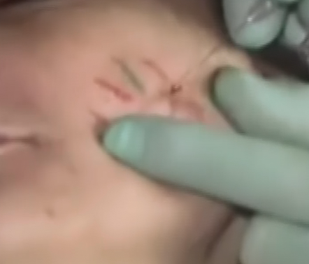 ELLANSÉ™注射调节面部轮廓与填充面颊