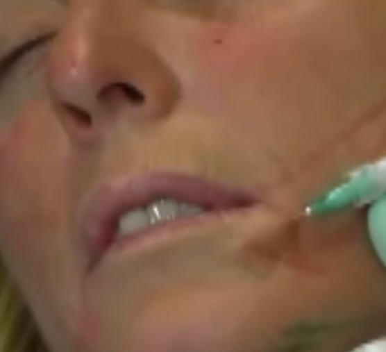 ELLANSÉ™面部全方位填充