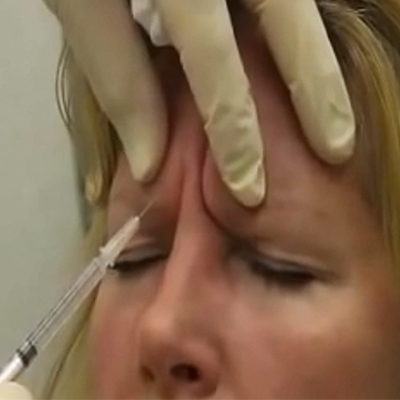 肉毒杆菌注射消除眉间纹