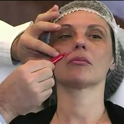 解决嘴角肉、法令纹、下巴轮廓等多种问题