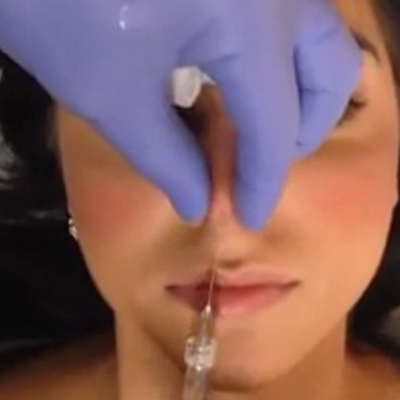 医学博士玻尿酸隆鼻