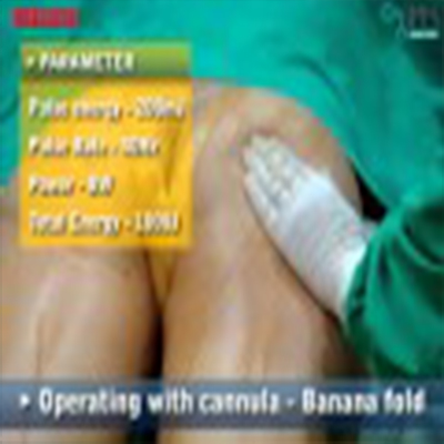 整形外科手术：大腿部抽脂