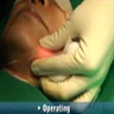 整形手术：下巴部位镭射溶脂