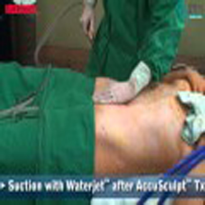 整形外科手术：腹部抽脂溶脂