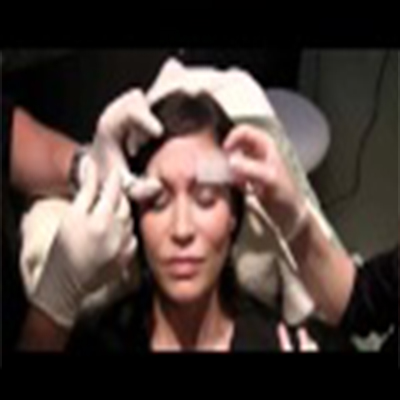 Botox注射提升眉部