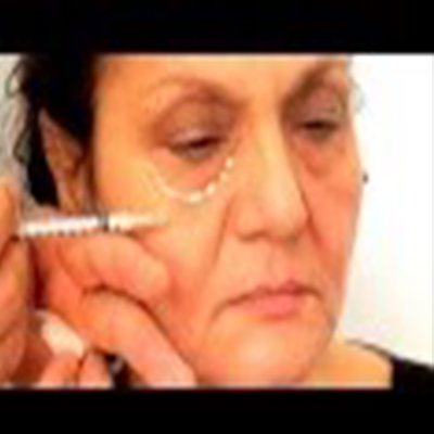 玻尿酸注射治疗眼袋、法令纹