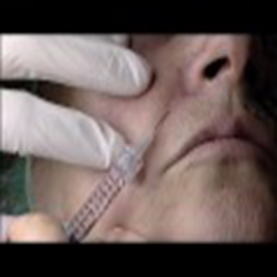 玻尿酸填充面部、丰唇