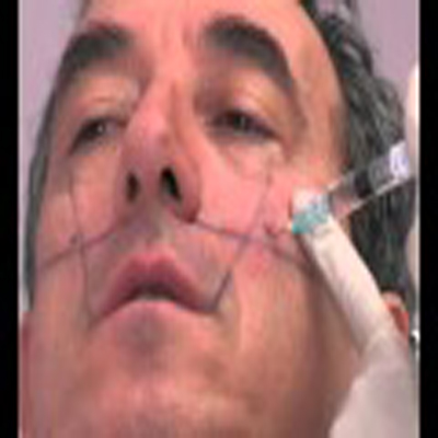 颚骨注射填充消除凹陷