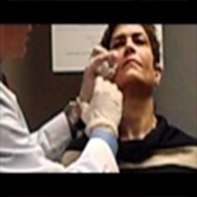 玻尿酸注射治疗鼻唇沟