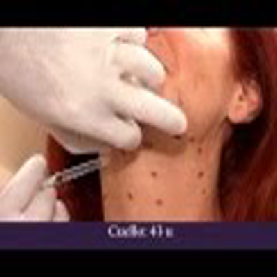 肉毒杆菌注射消除颈部皱纹