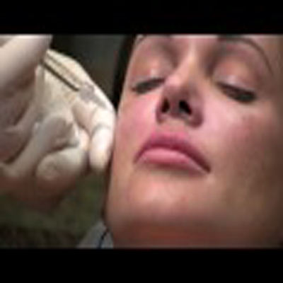 注射液体填充剂隆颊