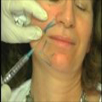 消除眼部、鼻部、嘴部皱纹