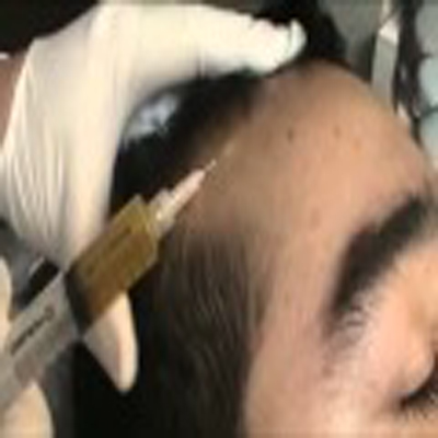 PRP注射治疗治疗脱发