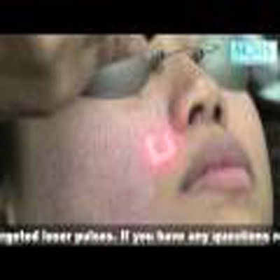 点阵激光美白保养皮肤