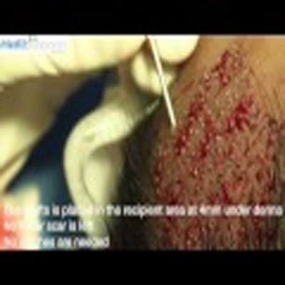 解决脱发头发移植