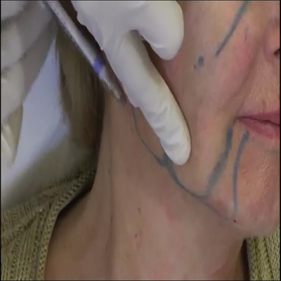 注射微晶瓷：面部祛除皱纹