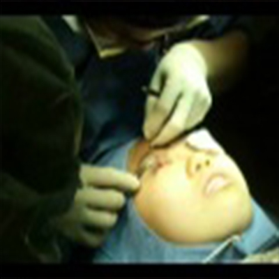 外科整容手术：重睑手术