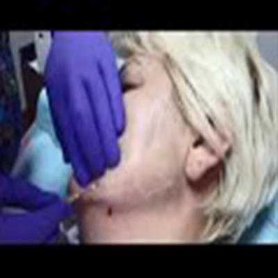 面部埋线法：脸颊轮廓与提拉