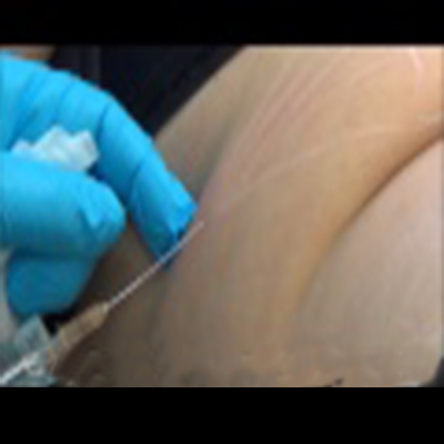 溶脂针注射消除脂肪