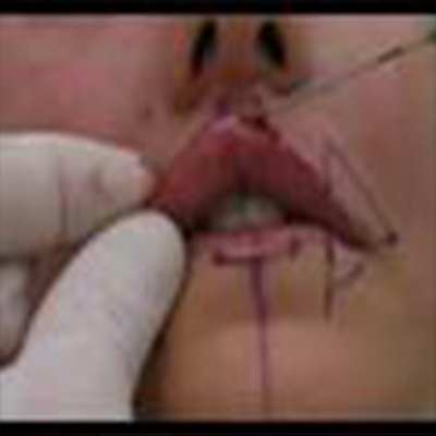 注射填充丰满唇部