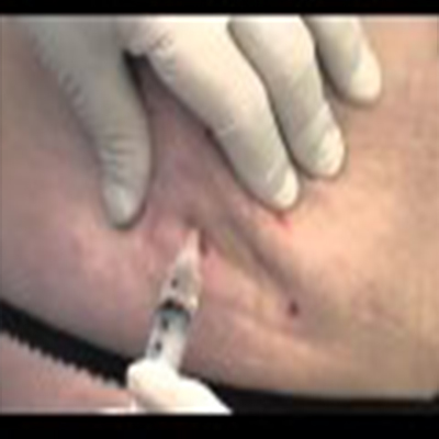 溶脂针消除腰部赘肉