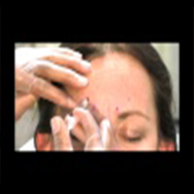 BOTOX肉毒消除眉部皱纹