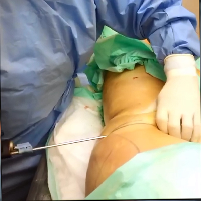 抽脂手术：大腿部赘肉