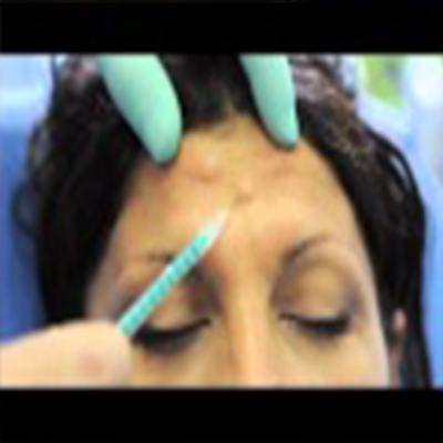 肉毒杆菌消除额头纹