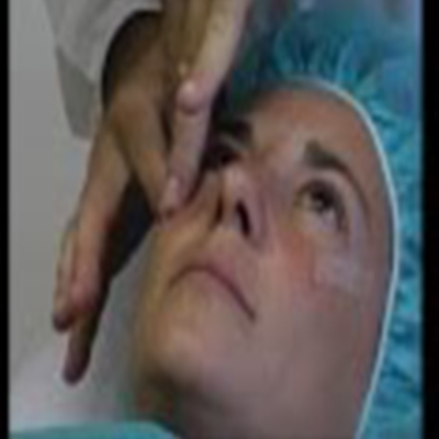 肉毒杆菌消除眼眉部皱纹