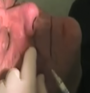 嘴角、下巴的皱纹消除