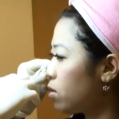 玻尿酸注射填充隆鼻