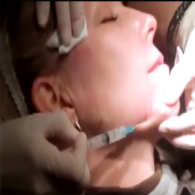 童颜针面部注射